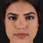 Rhinoplasty Before & After Patient #2862