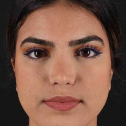 Rhinoplasty Before & After Patient #2862