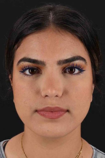 Rhinoplasty Before & After Patient #2862