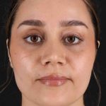 Rhinoplasty Before & After Patient #2873