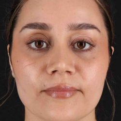 Rhinoplasty Before & After Patient #2873