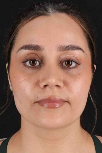 Rhinoplasty Before & After Patient #2873