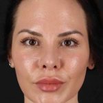 Rhinoplasty Before & After Patient #2884