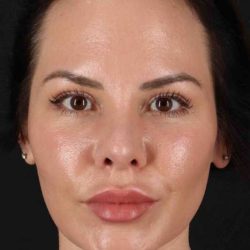 Rhinoplasty Before & After Patient #2884