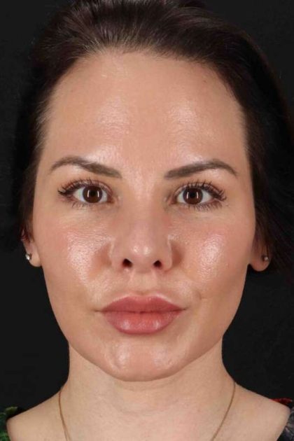 Rhinoplasty Before & After Patient #2884
