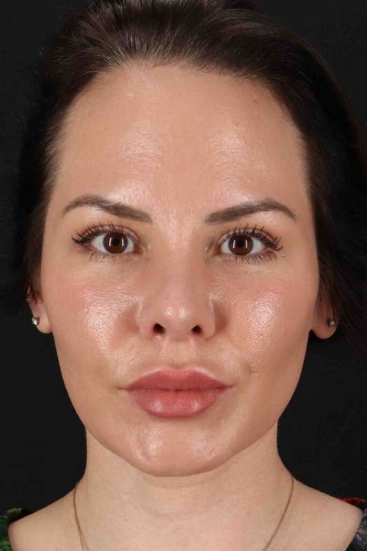 Rhinoplasty Before & After Patient #2884