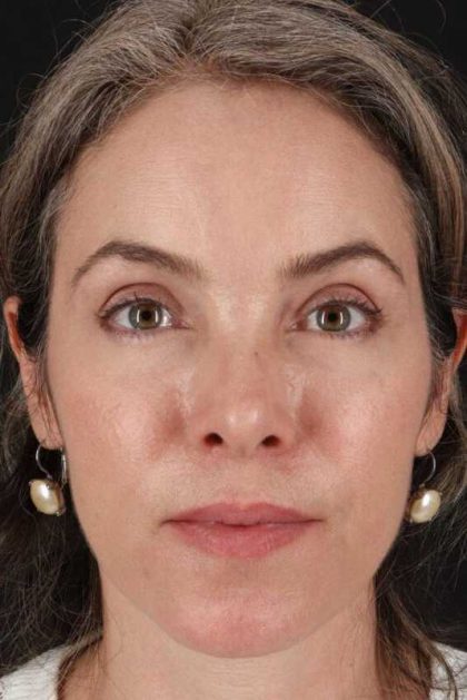 Browlift Before & After Patient #1231