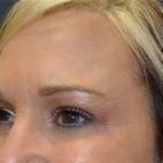 Browlift Before & After Patient #1405