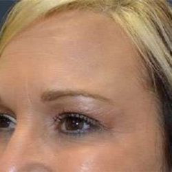 Browlift Before & After Patient #1405