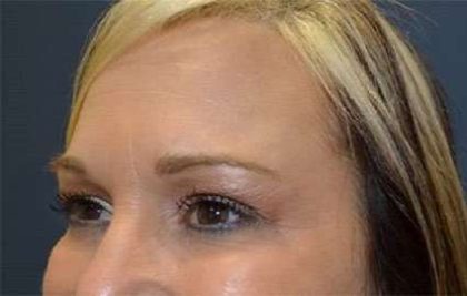 Browlift Before & After Patient #1405