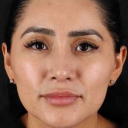 Rhinoplasty Before & After Patient #2895