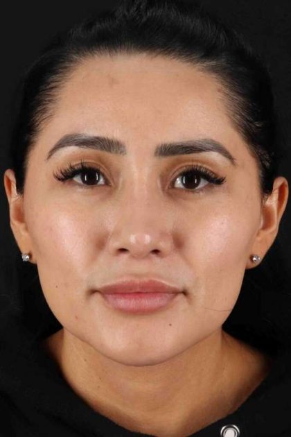 Rhinoplasty Before & After Patient #2895