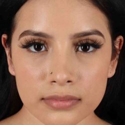 Rhinoplasty Before & After Patient #2917