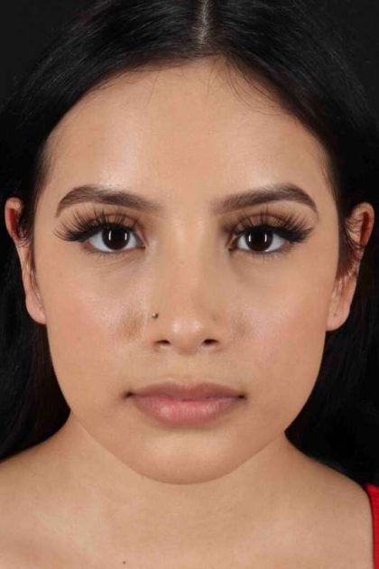 Rhinoplasty Before & After Patient #2917