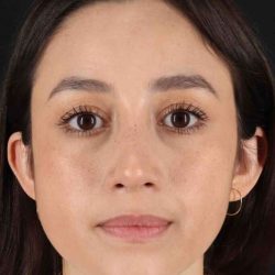 Rhinoplasty Before & After Patient #2928