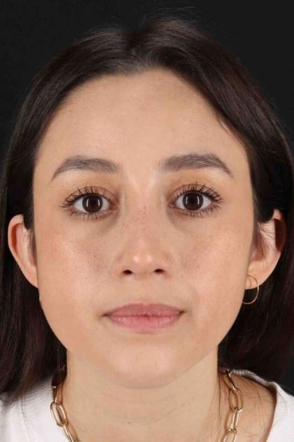 Rhinoplasty Before & After Patient #2928
