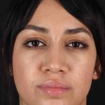 Rhinoplasty Before & After Patient #2939