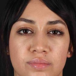Rhinoplasty Before & After Patient #2939