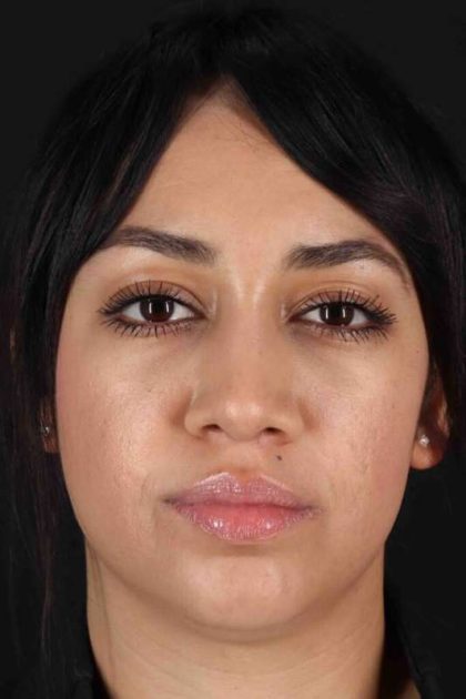 Rhinoplasty Before & After Patient #2939