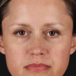 Rhinoplasty Before & After Patient #2950