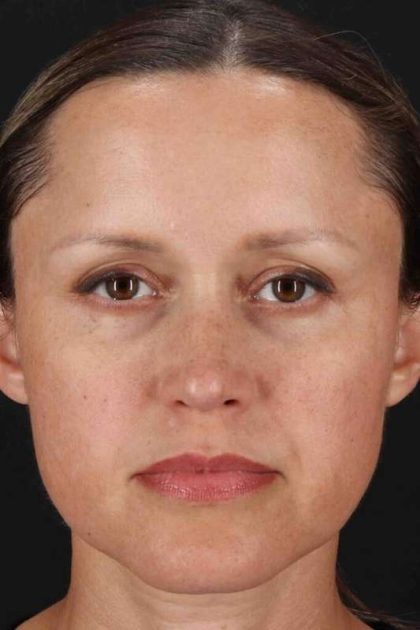 Rhinoplasty Before & After Patient #2950