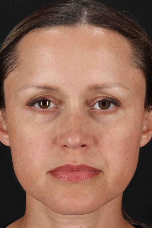 Rhinoplasty Before & After Patient #2950