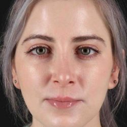 Rhinoplasty Before & After Patient #2961