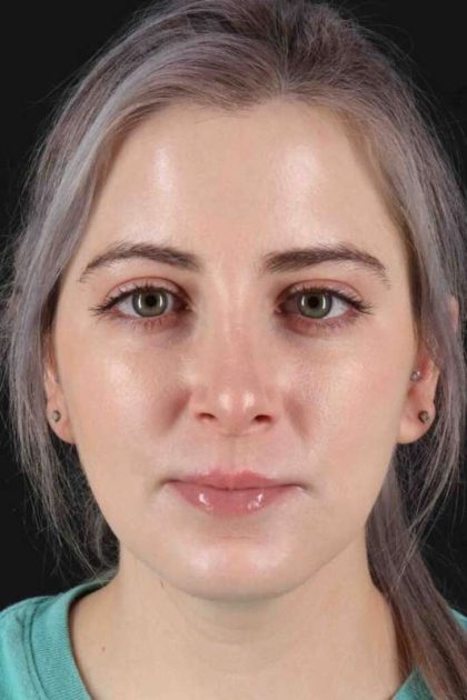 Rhinoplasty Before & After Patient #2961