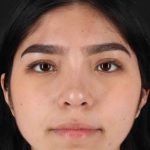 Rhinoplasty Before & After Patient #2972