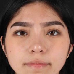 Rhinoplasty Before & After Patient #2972