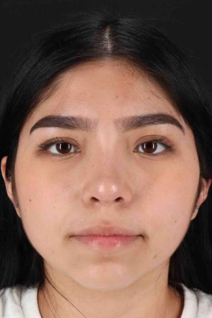 Rhinoplasty Before & After Patient #2972