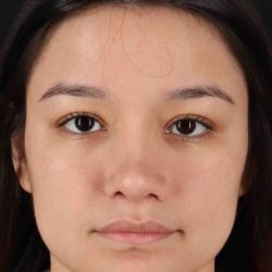 Rhinoplasty Before & After Patient #2983