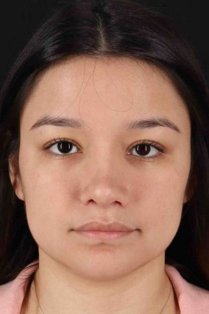 Rhinoplasty Before & After Patient #2983