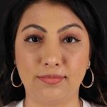 Rhinoplasty Before & After Patient #2994