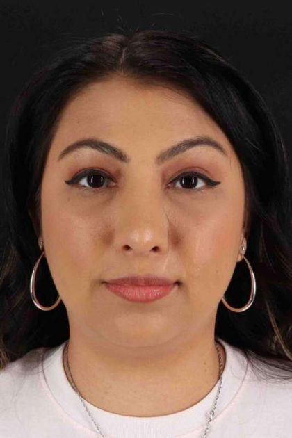 Rhinoplasty Before & After Patient #2994