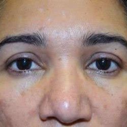 Browlift Before & After Patient #1408