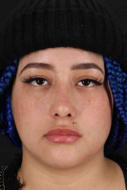 Rhinoplasty Before & After Patient #3016