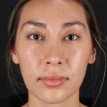 Rhinoplasty Before & After Patient #3027