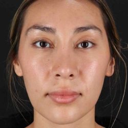 Rhinoplasty Before & After Patient #3027