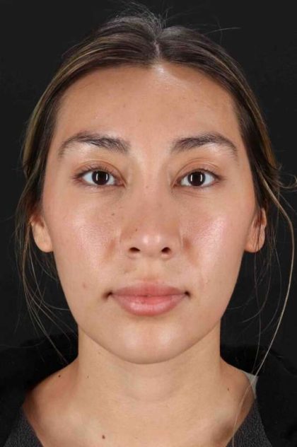 Rhinoplasty Before & After Patient #3027