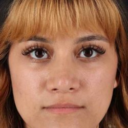 Rhinoplasty Before & After Patient #3038