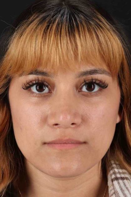 Rhinoplasty Before & After Patient #3038