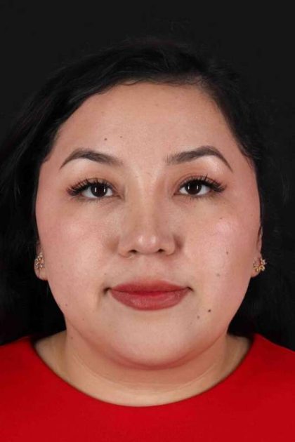 Rhinoplasty Before & After Patient #3060
