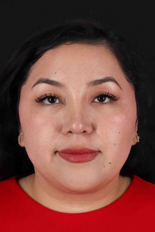 Rhinoplasty Before & After Patient #3060
