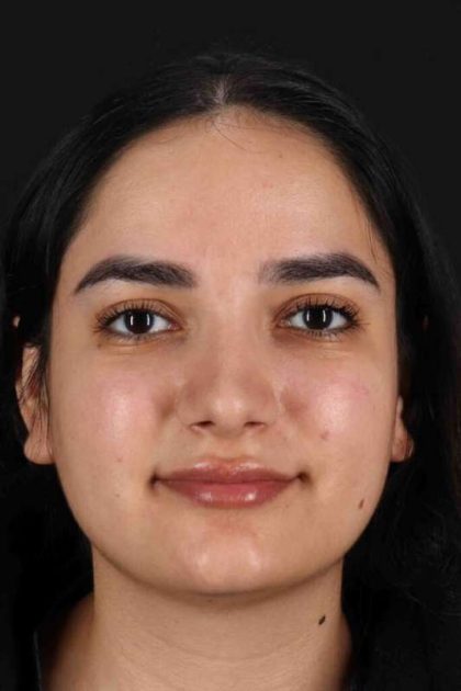 Rhinoplasty Before & After Patient #3071
