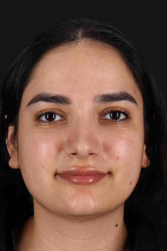 Rhinoplasty Before & After Patient #3071