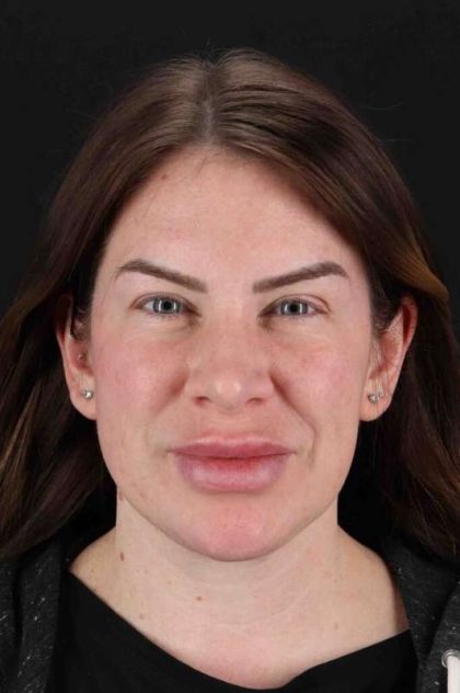 Rhinoplasty Before & After Patient #3093