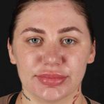 Rhinoplasty Before & After Patient #3104