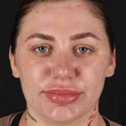Rhinoplasty Before & After Patient #3104