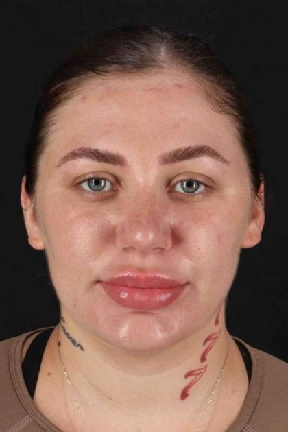 Rhinoplasty Before & After Patient #3104